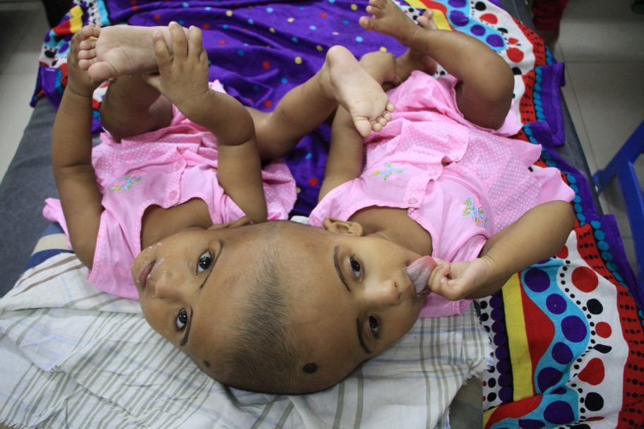 Hungarian Doctors Successfully Separate Siamese Twins Conjoined At Head